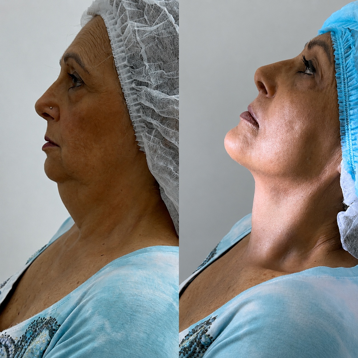 Resultado lipo de papada – IV Clínic