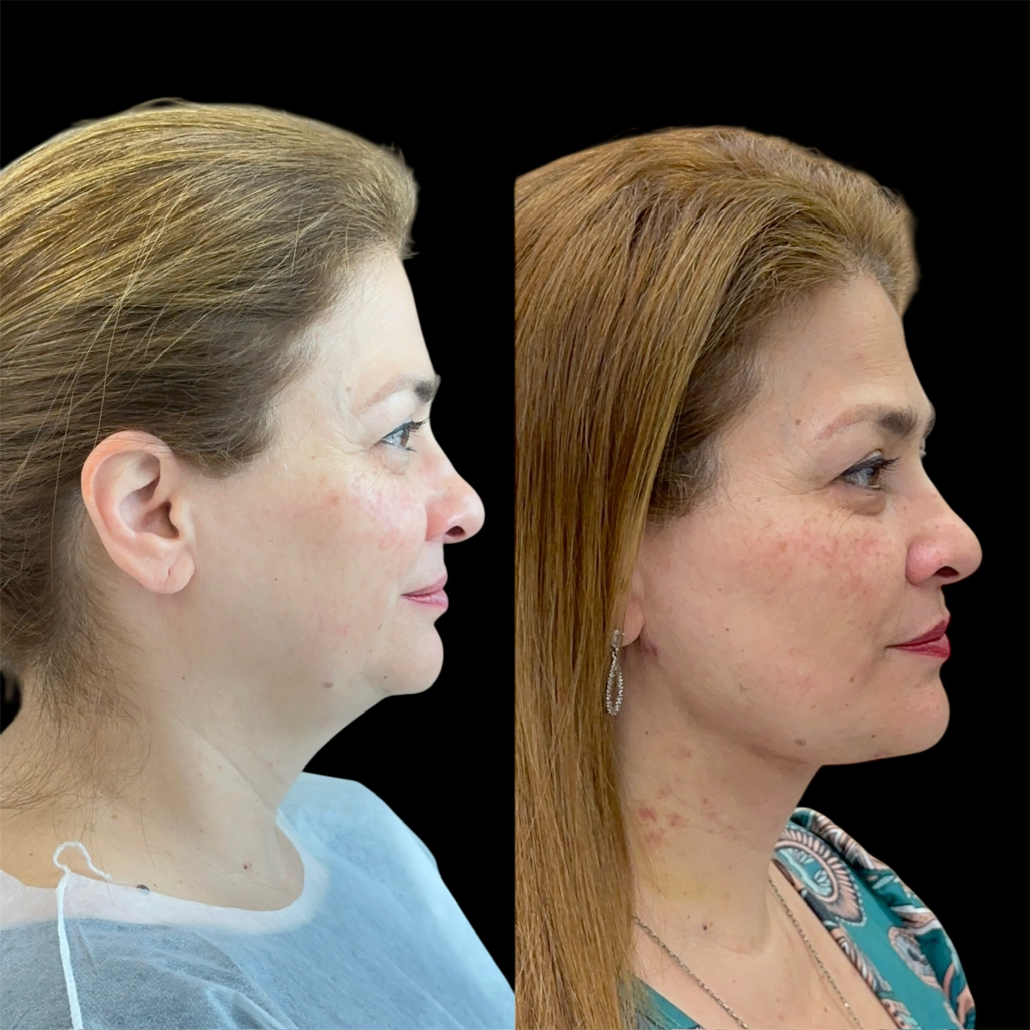 Antes e depois lipo de papada