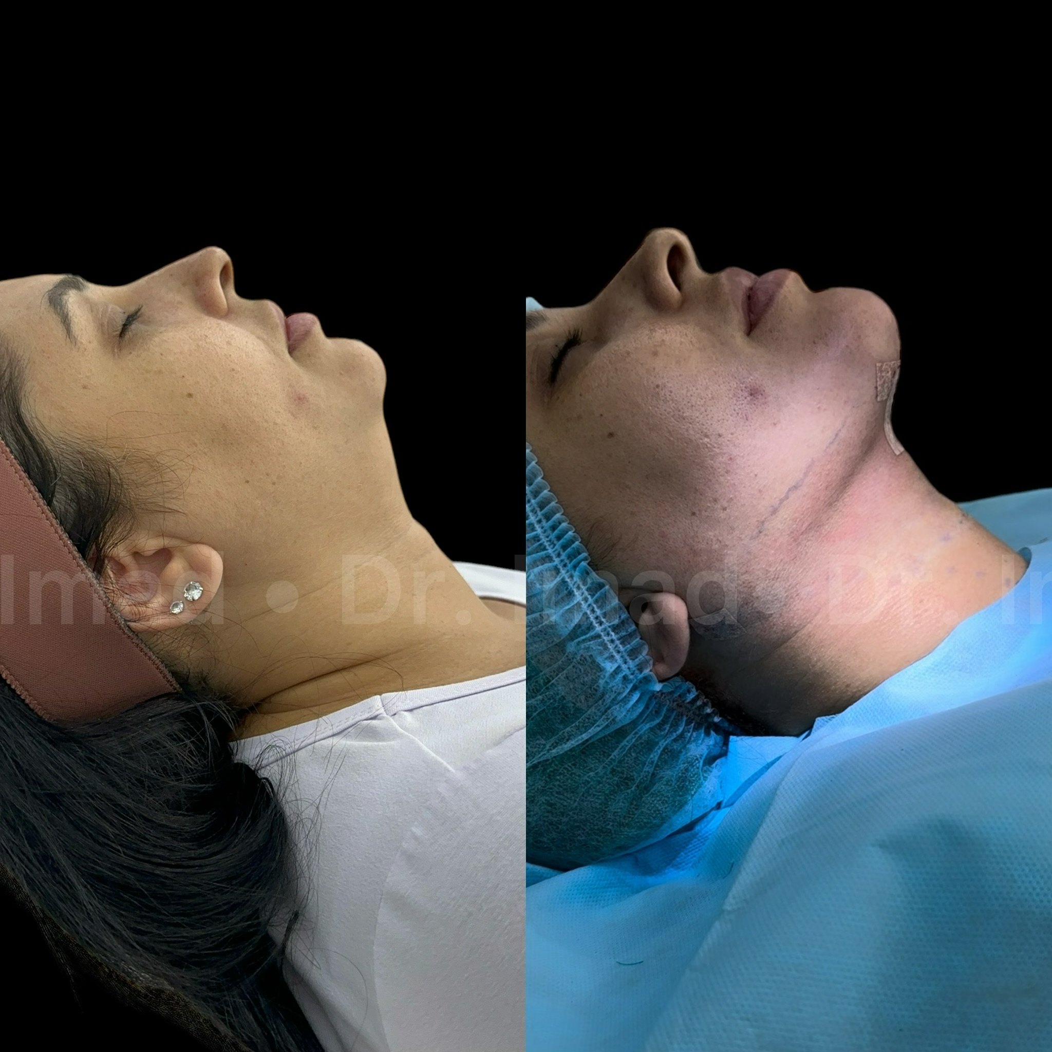 Antes e depois lipo de papada