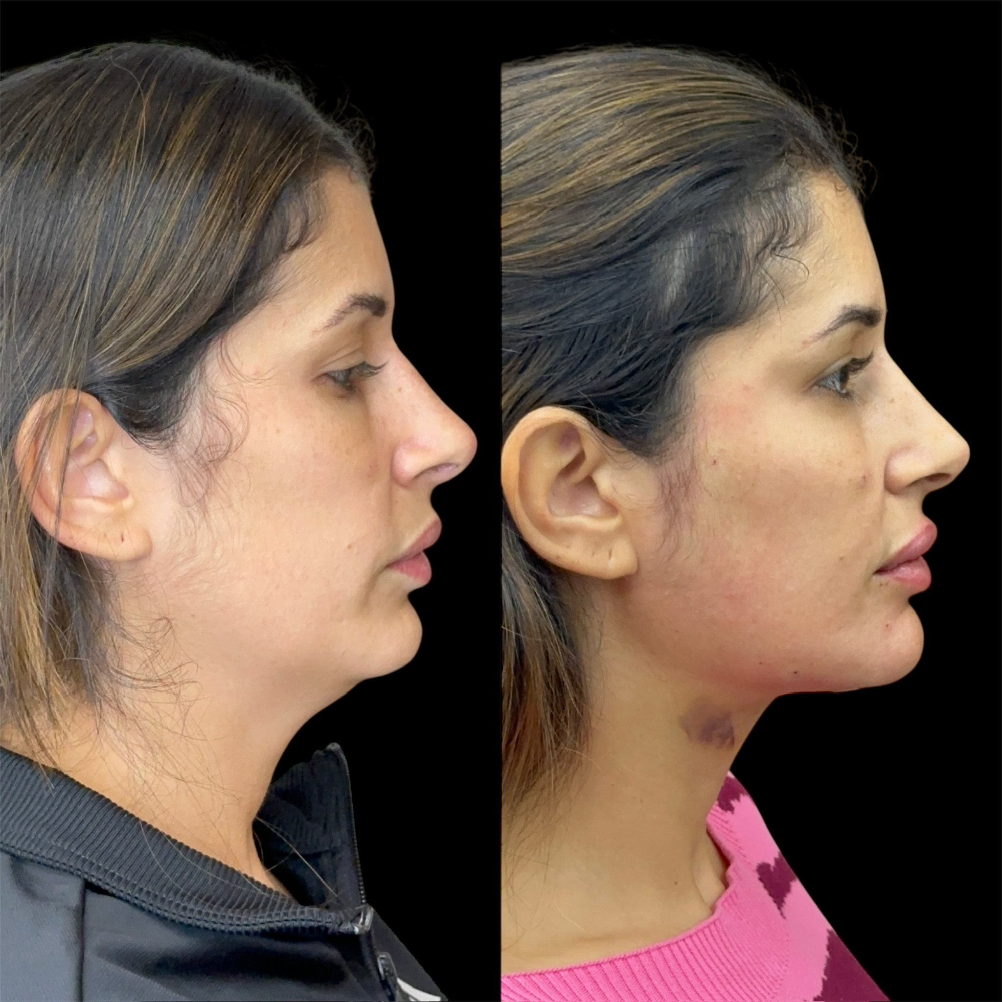 Antes e depois lipo de papada