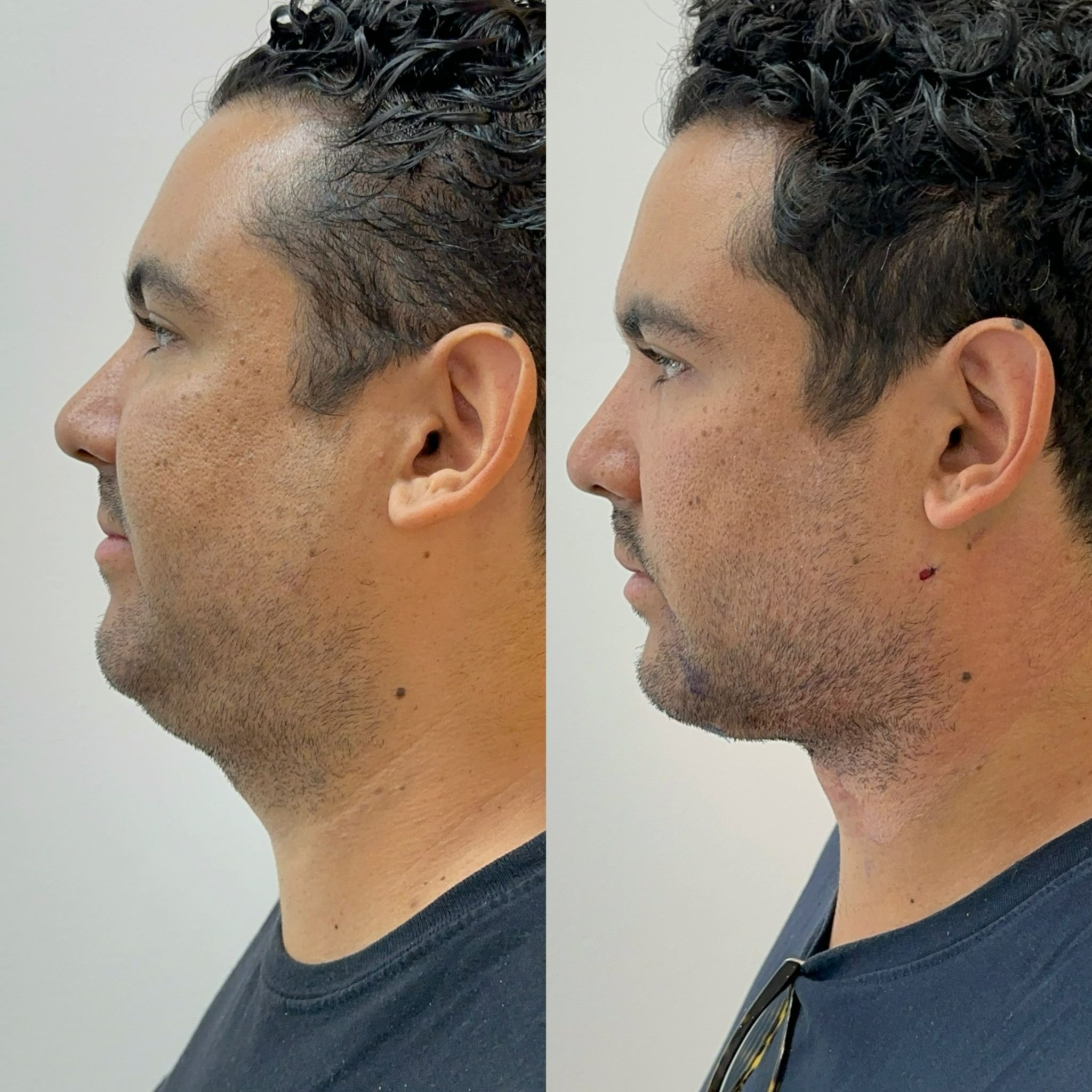 Antes e depois lipo de papada