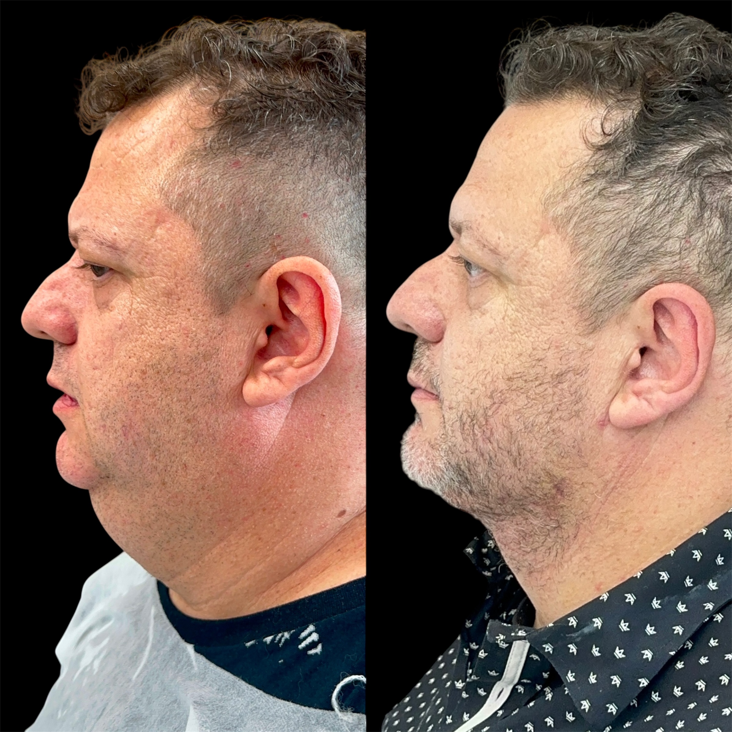 Antes e depois lipo de papada